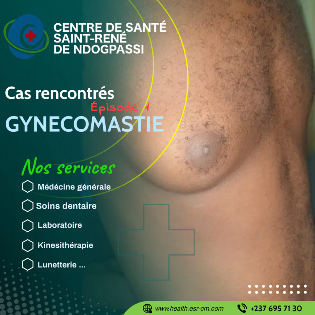 GYNECOMASTIE
